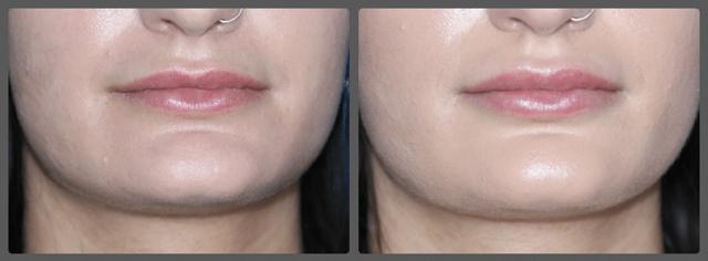 Juvederm result at Troell Cosmetic Surgery & Facial Plastic Clinic in Las Vegas, NV