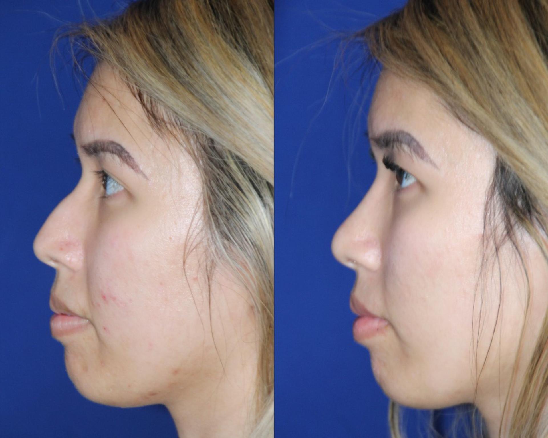 Troell Cosmetic Surgery & Facial Plastic Clinic rhinoplasty result — Las Vegas, NV