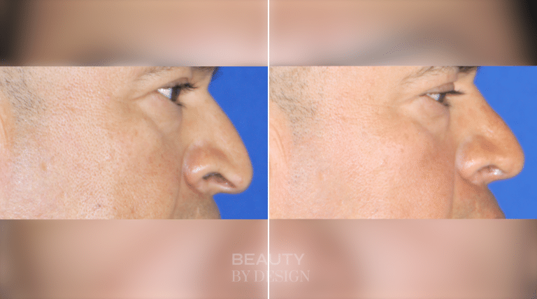 Troell Cosmetic Surgery & Facial Plastic Clinic rhinoplasty result — Las Vegas, NV