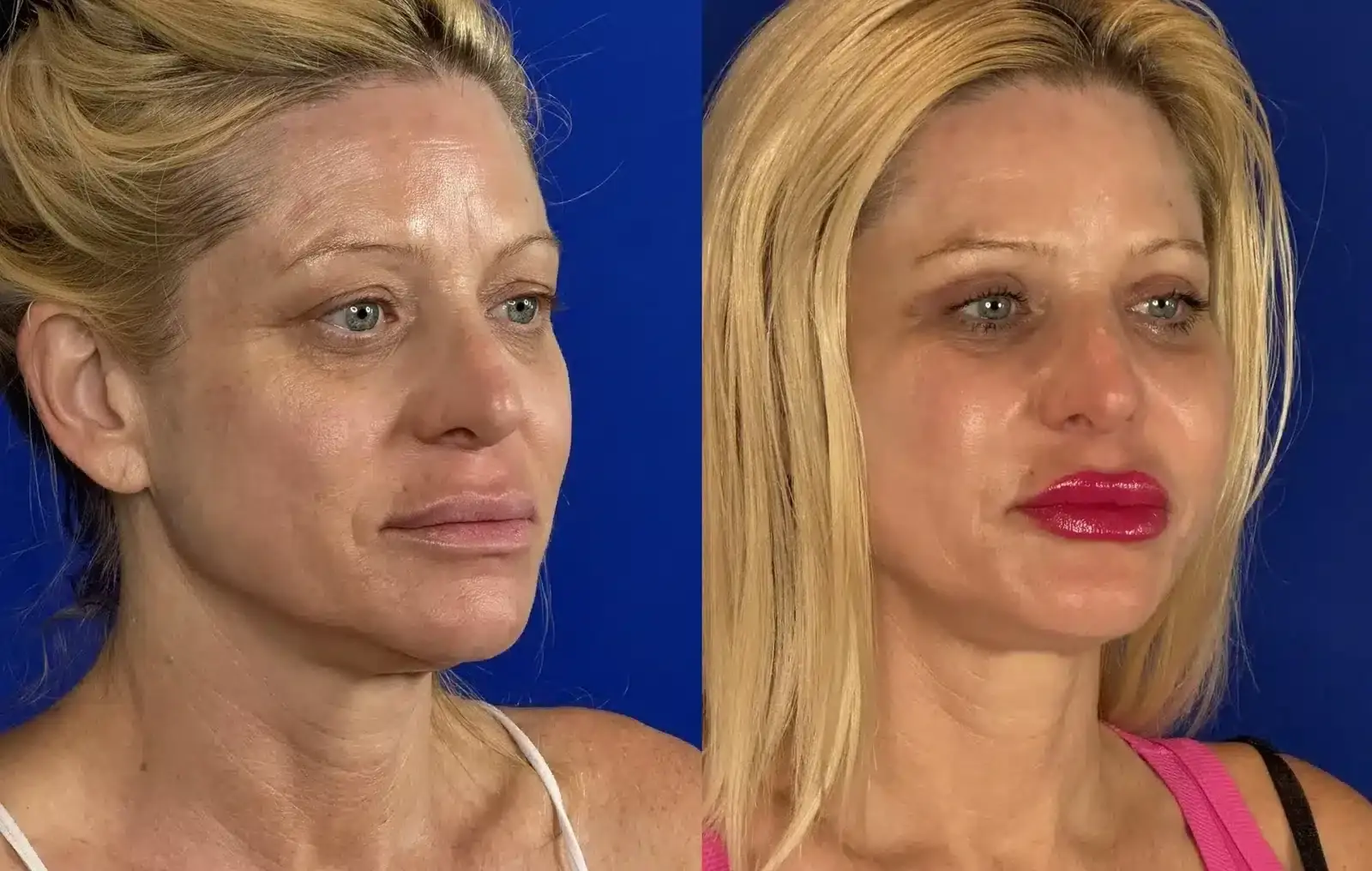 Troell Cosmetic Surgery & Facial Plastic Clinic cheek implant result — Las Vegas, NV