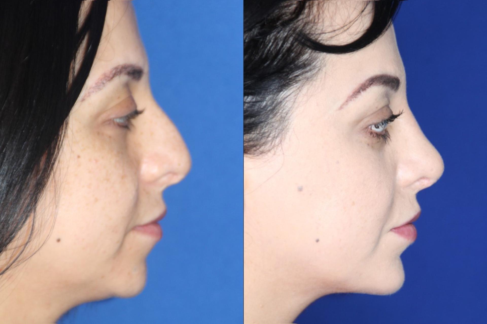Troell Cosmetic Surgery & Facial Plastic Clinic rhinoplasty result — Las Vegas, NV