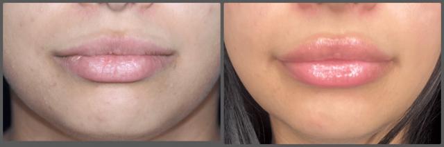 Juvederm result at Troell Cosmetic Surgery & Facial Plastic Clinic in Las Vegas, NV