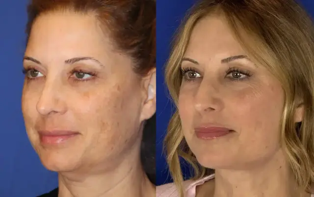 Neck Lift result at Troell Cosmetic Surgery & Facial Plastic Clinic in Las Vegas, NV