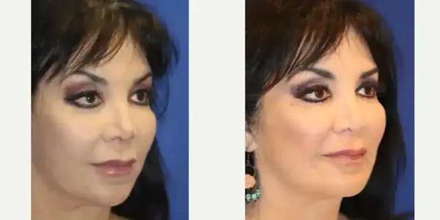 Chin Implant result at Troell Cosmetic Surgery & Facial Plastic Clinic in Las Vegas, NV