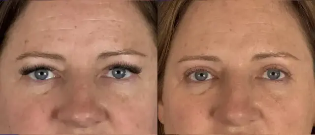 Blepharoplasty result at Troell Cosmetic Surgery & Facial Plastic Clinic in Las Vegas, NV
