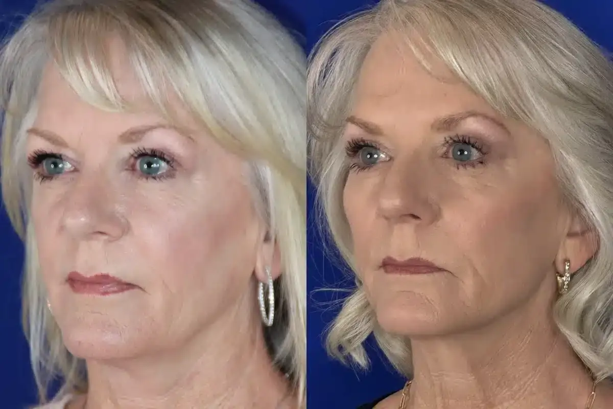 Troell Cosmetic Surgery & Facial Plastic Clinic cheek implant result — Las Vegas, NV