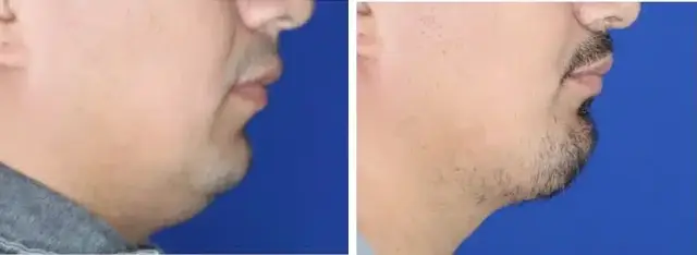Chin Implant result at Troell Cosmetic Surgery & Facial Plastic Clinic in Las Vegas, NV