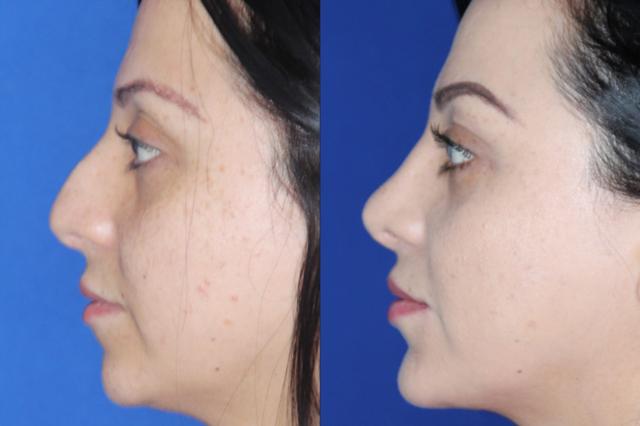 Functional Rhinoplasty result at Troell Cosmetic Surgery & Facial Plastic Clinic in Las Vegas, NV