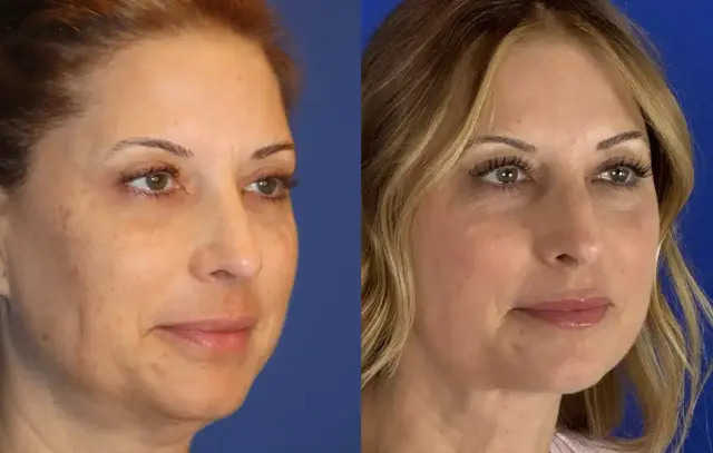 Neck Lift result at Troell Cosmetic Surgery & Facial Plastic Clinic in Las Vegas, NV