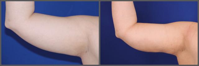 Liposuction result at Troell Cosmetic Surgery & Facial Plastic Clinic in Las Vegas, NV