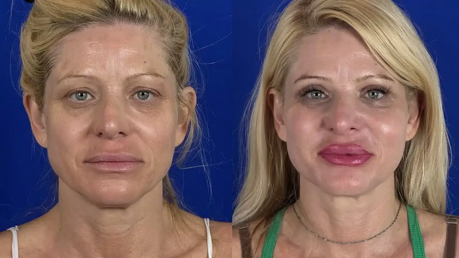 Troell Cosmetic Surgery & Facial Plastic Clinic cheek implant result — Las Vegas, NV