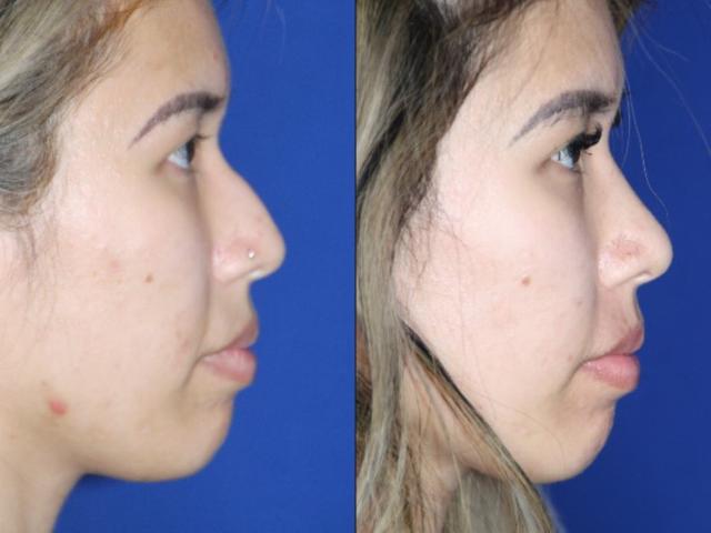 Rhinoplasty result at Troell Cosmetic Surgery & Facial Plastic Clinic in Las Vegas, NV