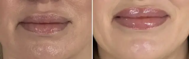 Juvederm result at Troell Cosmetic Surgery & Facial Plastic Clinic in Las Vegas, NV