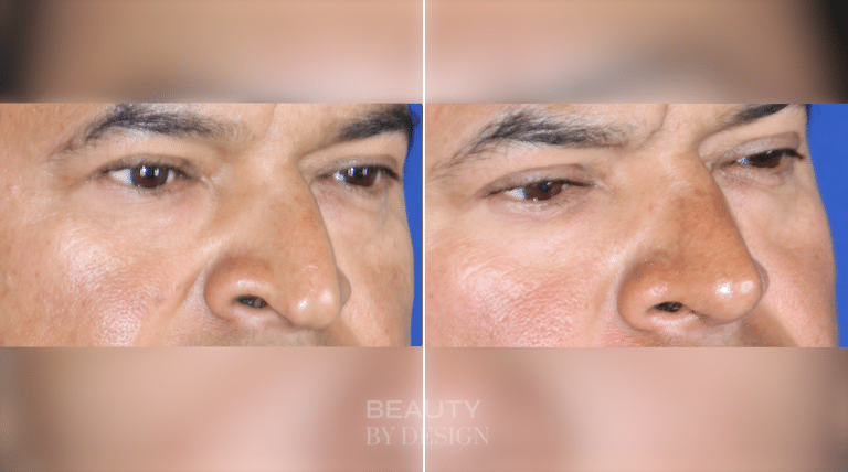 Troell Cosmetic Surgery & Facial Plastic Clinic rhinoplasty result — Las Vegas, NV