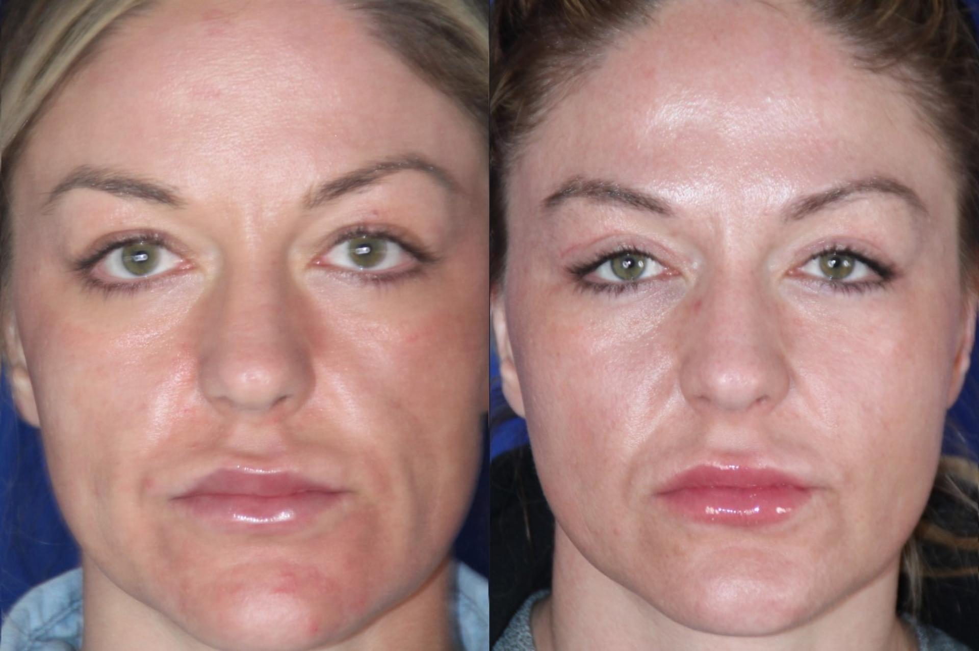 Troell Cosmetic Surgery & Facial Plastic Clinic cheek implant result — Las Vegas, NV