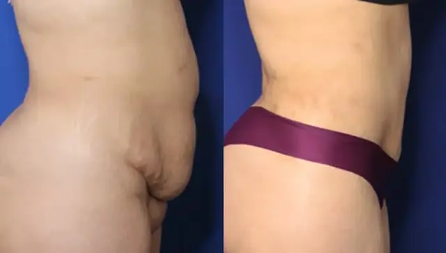 Mini Tummy Tuck result at Troell Cosmetic Surgery & Facial Plastic Clinic in Las Vegas, NV