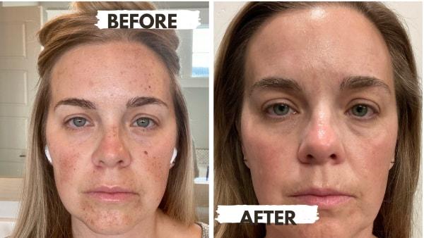 Sweet Spot Spa and Enrichment Center photofacial result — Boise, ID