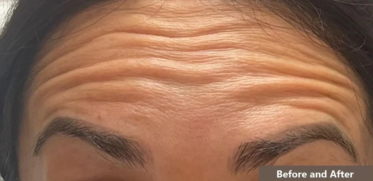 Tahira Aesthetics and Lasers result — Sugar Land, TX