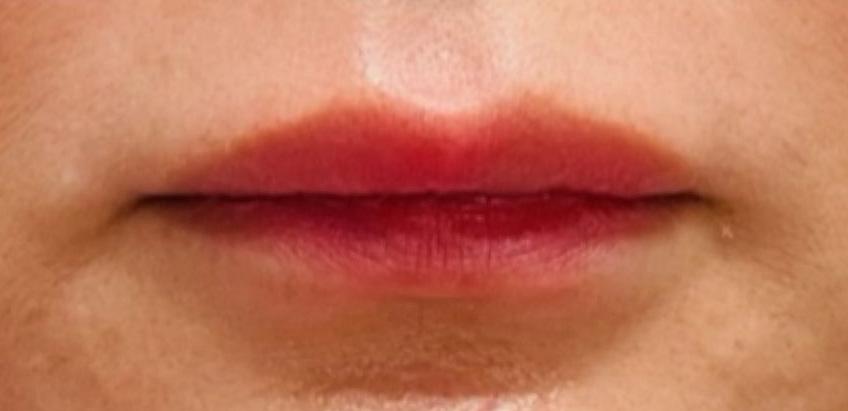 Tahira Aesthetics and Lasers result — Sugar Land, TX
