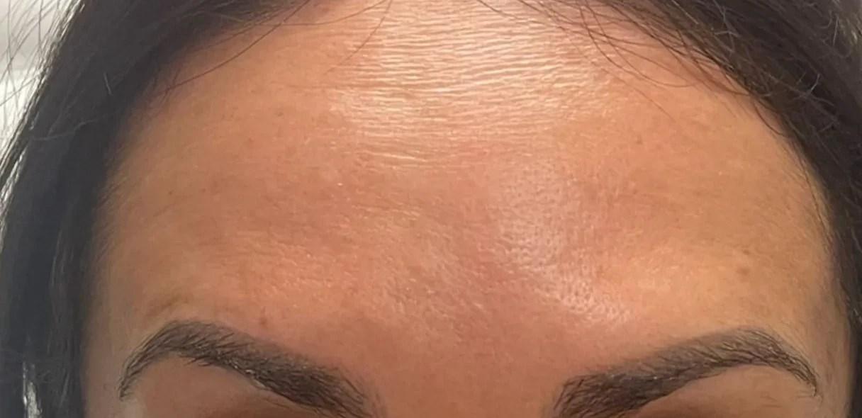 Tahira Aesthetics and Lasers result — Sugar Land, TX