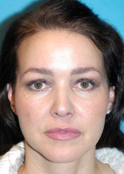 Romo Plastic Surgery facelift after — New York, NY