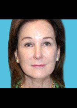 Romo Plastic Surgery facelift after — New York, NY