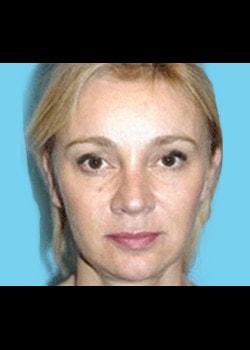 Romo Plastic Surgery facelift after — New York, NY