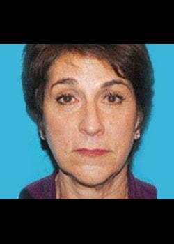 Romo Plastic Surgery facelift after — New York, NY