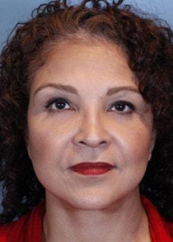 Romo Plastic Surgery brow lift after — New York, NY
