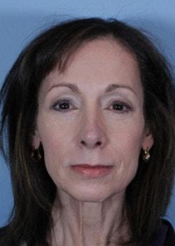 Romo Plastic Surgery brow lift after — New York, NY