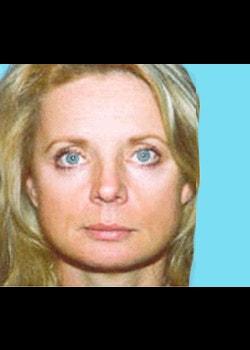 Romo Plastic Surgery facelift after — New York, NY