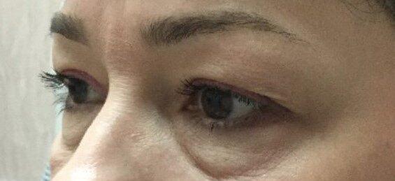 Blepharoplasty before at Dr. Roman Rayham, MD in Brooklyn, NY