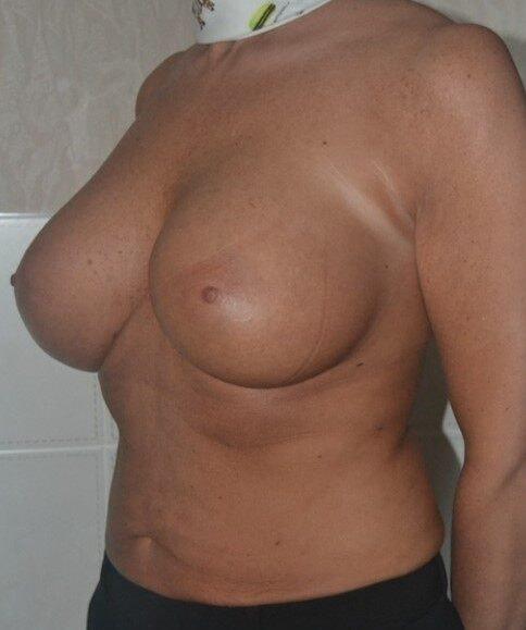 Breast Lift after at Dr. Roman Rayham, MD in Brooklyn, NY