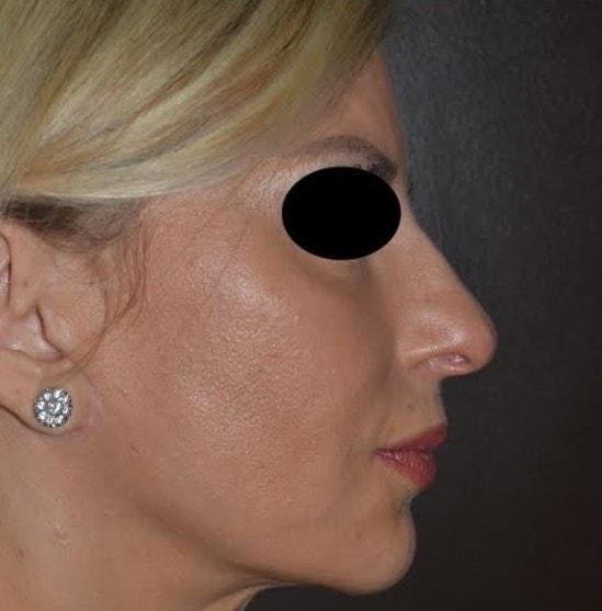 Deep Plane Facelift after at Dr. Roman Rayham, MD in Brooklyn, NY