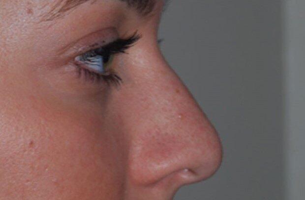 Rhinoplasty before at Dr. Roman Rayham, MD in Brooklyn, NY