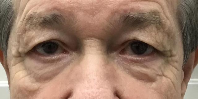Blepharoplasty before at Dr. Roman Rayham, MD in Brooklyn, NY