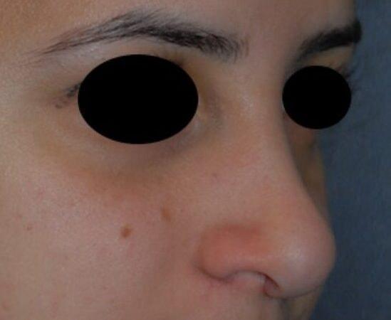Rhinoplasty after at Dr. Roman Rayham, MD in Brooklyn, NY