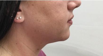 Dr. Roman Rayham, MD arm lift after — Brooklyn, NY