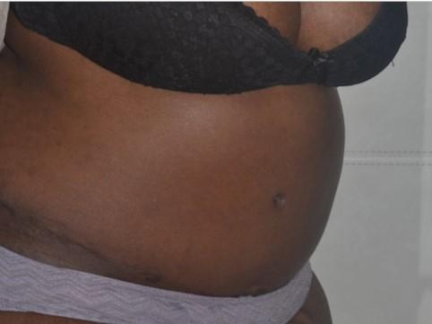Mini Tummy Tuck after at Dr. Roman Rayham, MD in Brooklyn, NY