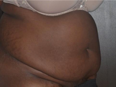 Mini Tummy Tuck before at Dr. Roman Rayham, MD in Brooklyn, NY