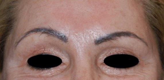Brow Lift before at Dr. Roman Rayham, MD in Brooklyn, NY