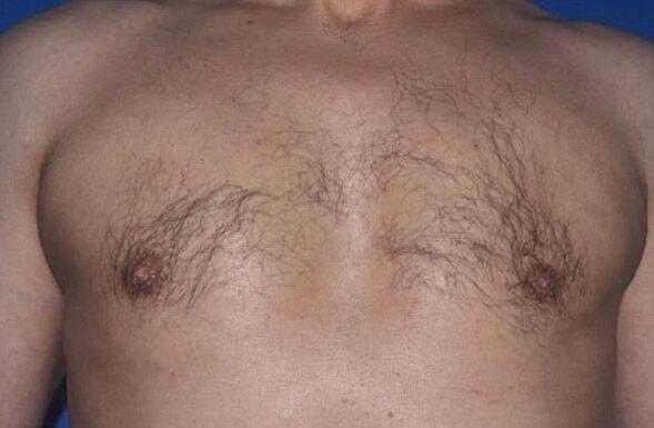 Gynecomastia Surgery after at Dr. Roman Rayham, MD in Brooklyn, NY
