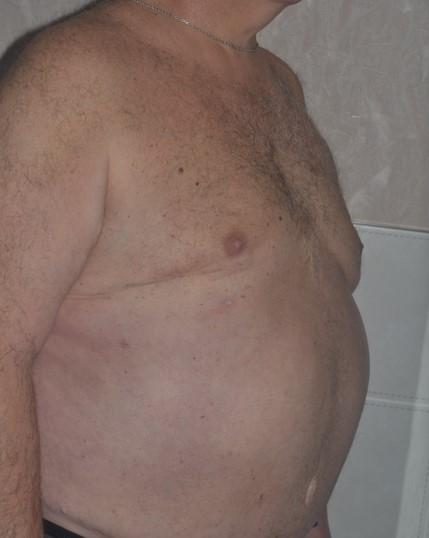 Mini Tummy Tuck after at Dr. Roman Rayham, MD in Brooklyn, NY