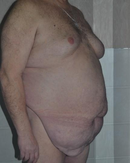 Mini Tummy Tuck before at Dr. Roman Rayham, MD in Brooklyn, NY