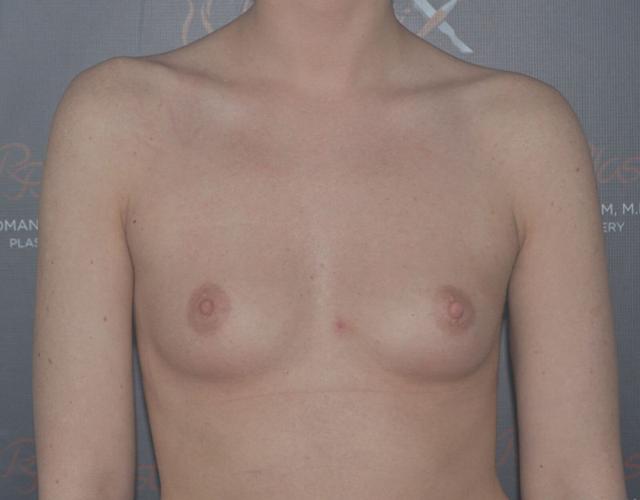 Breast Lift before at Dr. Roman Rayham, MD in Brooklyn, NY