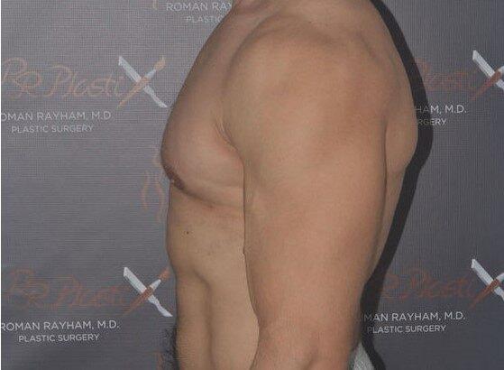 Gynecomastia Surgery after at Dr. Roman Rayham, MD in Brooklyn, NY