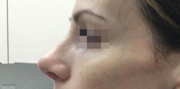 Rhinoplasty after at Dr. Roman Rayham, MD in Brooklyn, NY