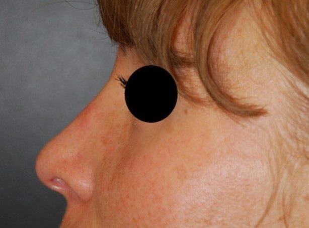 Rhinoplasty after at Dr. Roman Rayham, MD in Brooklyn, NY