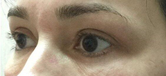 Blepharoplasty after at Dr. Roman Rayham, MD in Brooklyn, NY