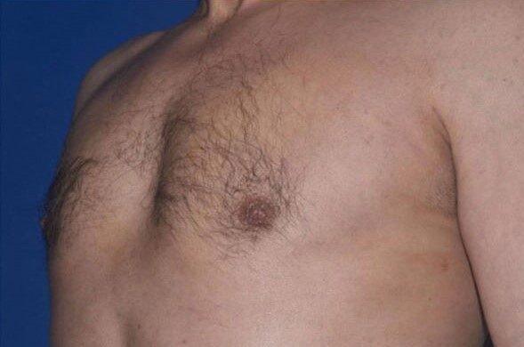 Gynecomastia Surgery after at Dr. Roman Rayham, MD in Brooklyn, NY